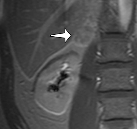 Guz nadnercza MRI rekonstrukcja 3d